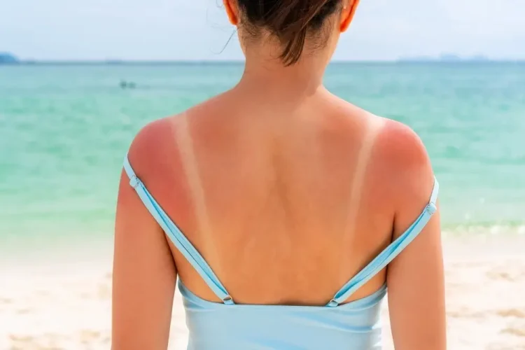 Sunburn Relief Tips