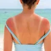 Sunburn Relief Tips